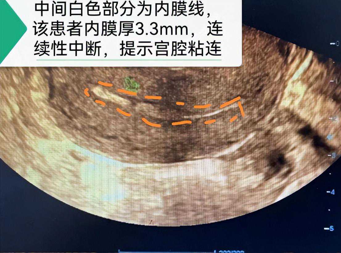 香港化验血能查男女需要多少钱,宫腔粘连能直接做试管吗？
