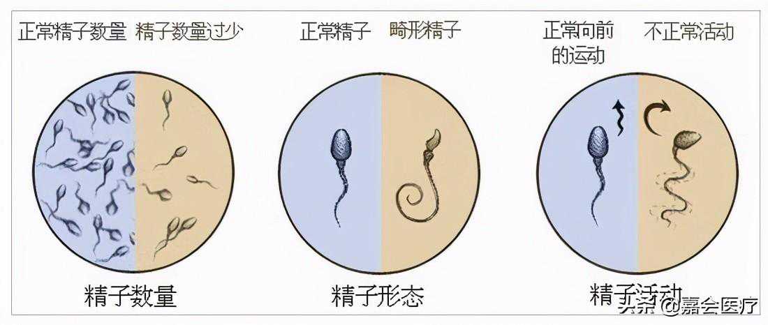 到香港验血查性别费用,肥胖男性的精子质量低会导致不孕不育？