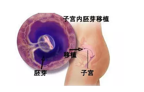 香港7周验血为什么合法,试管婴儿移植时放单胎或双胎哪种好？