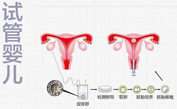 正规香港孕妇验血费用,试管促排方案决定移植具体时间，降调针多久能移植