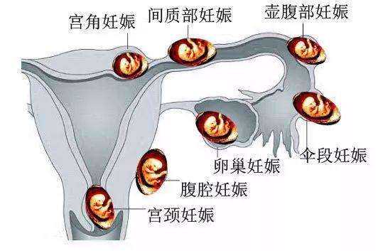香港验血为什么合法,避免宫外孕，做试管婴儿对了吗？