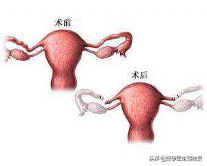 香港验血中心有哪些项目,备孕科普：输卵管结扎后又想要孩子，怎样做能快速